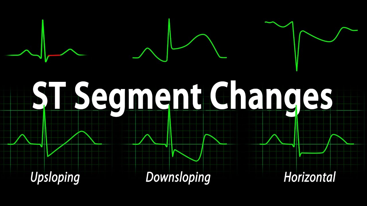 You are currently viewing ECG Interpretation Basics – ST Segment Changes. See link for real voice update in description!