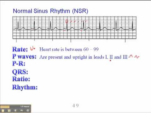 You are currently viewing ECG: Normal Sinus Rhythm (NSR)
