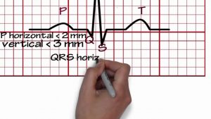 Read more about the article ECG Reading- 1