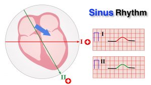 Read more about the article ECG basics 7/10 – Determining Normal Sinus Rhythm