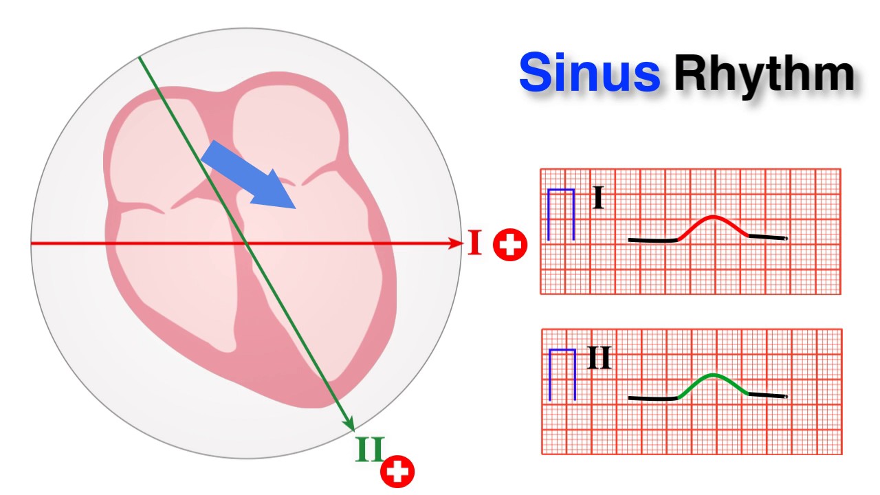 You are currently viewing ECG basics 7/10 – Determining Normal Sinus Rhythm
