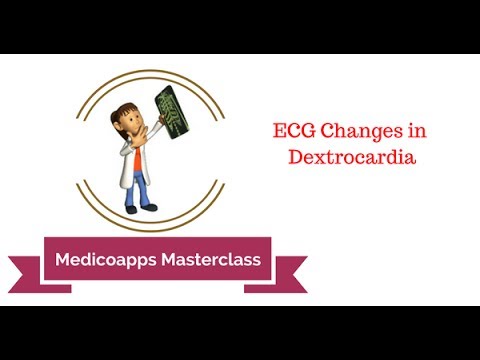 You are currently viewing ECG in Dextrocardia
