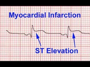 ECG in Heart Attack