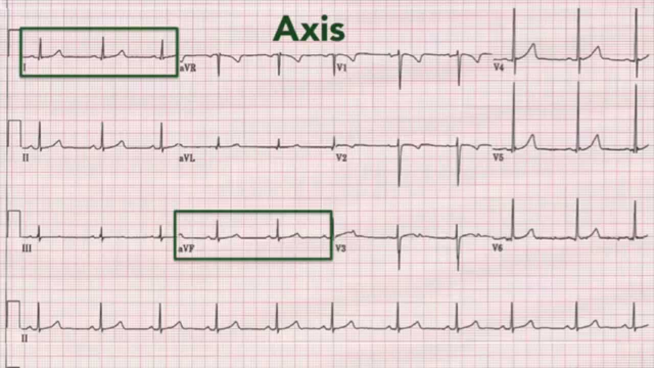 You are currently viewing ECG interpretation: recognising normal