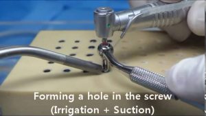 ESR KIT – SR Tip – Used To Remove Fractured Screw