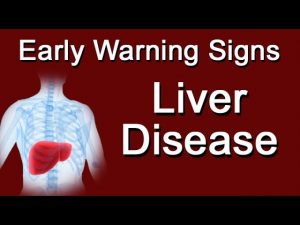 Read more about the article Early Warning Signs Of Liver Disease