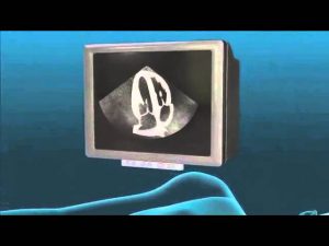 Read more about the article Echocardiogram Animation