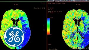 Read more about the article GE AW CT Perfusion 4D Radiology Imaging Software Video | GE Healthcare