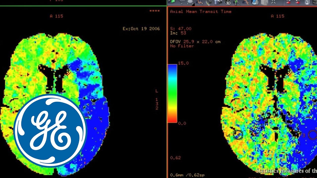 You are currently viewing GE AW CT Perfusion 4D Radiology Imaging Software Video | GE Healthcare