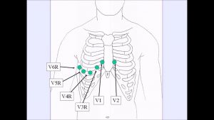 Read more about the article How To:  Complete Right Side ECG