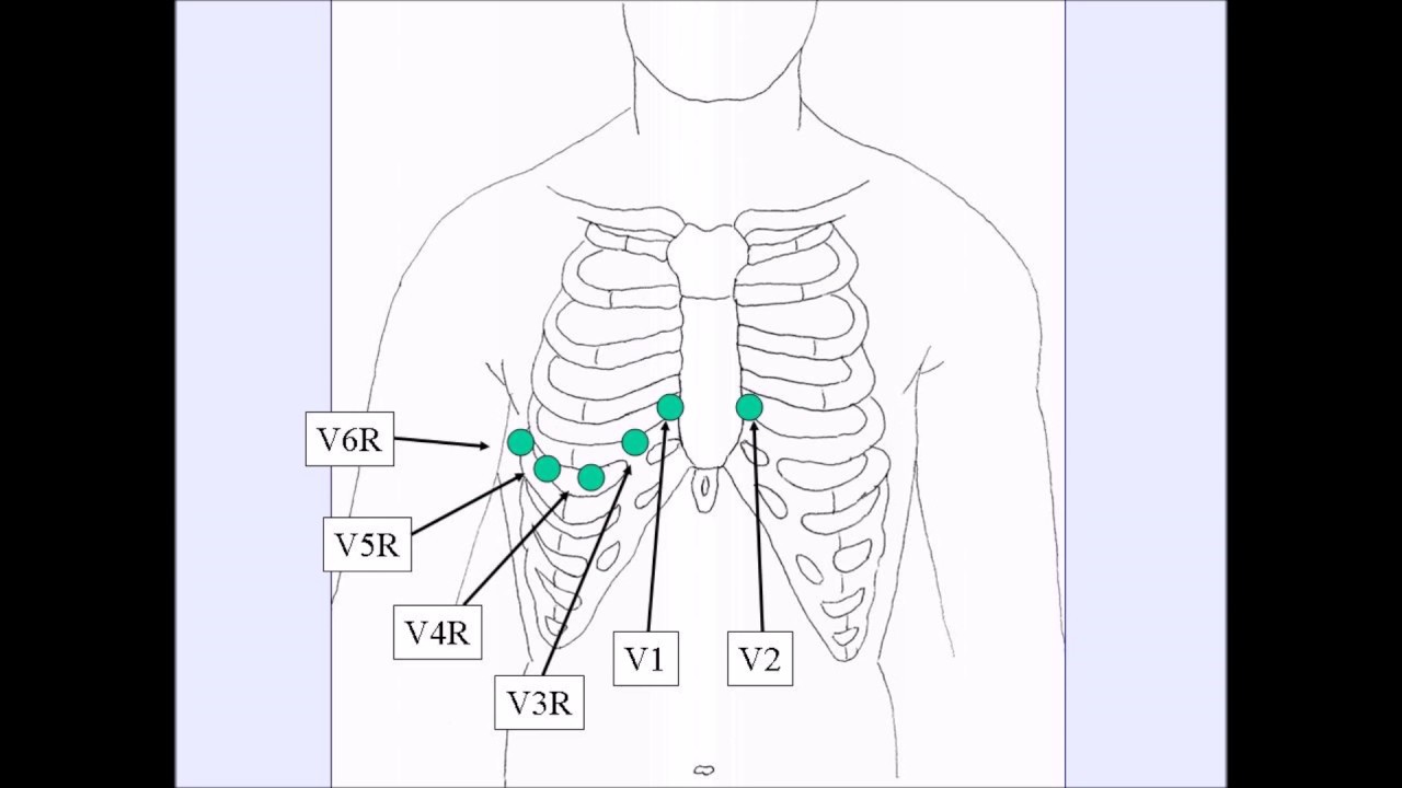 You are currently viewing How To:  Complete Right Side ECG