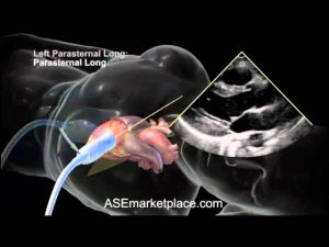 Read more about the article How to do a Basic Transthoracic Echocardiogram: Transducer Position and Anatomy