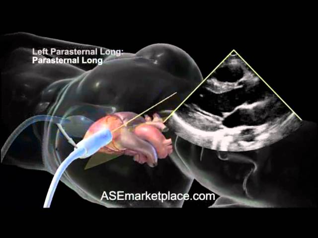 You are currently viewing How to do a Basic Transthoracic Echocardiogram: Transducer Position and Anatomy