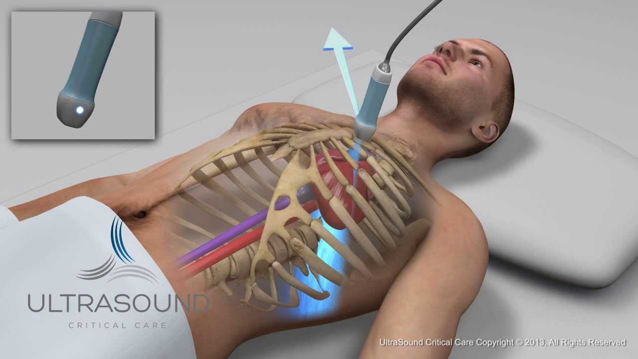 You are currently viewing How to obtain: Parasternal Long Axis Ultrasound View – Training and Techniques – ICU
