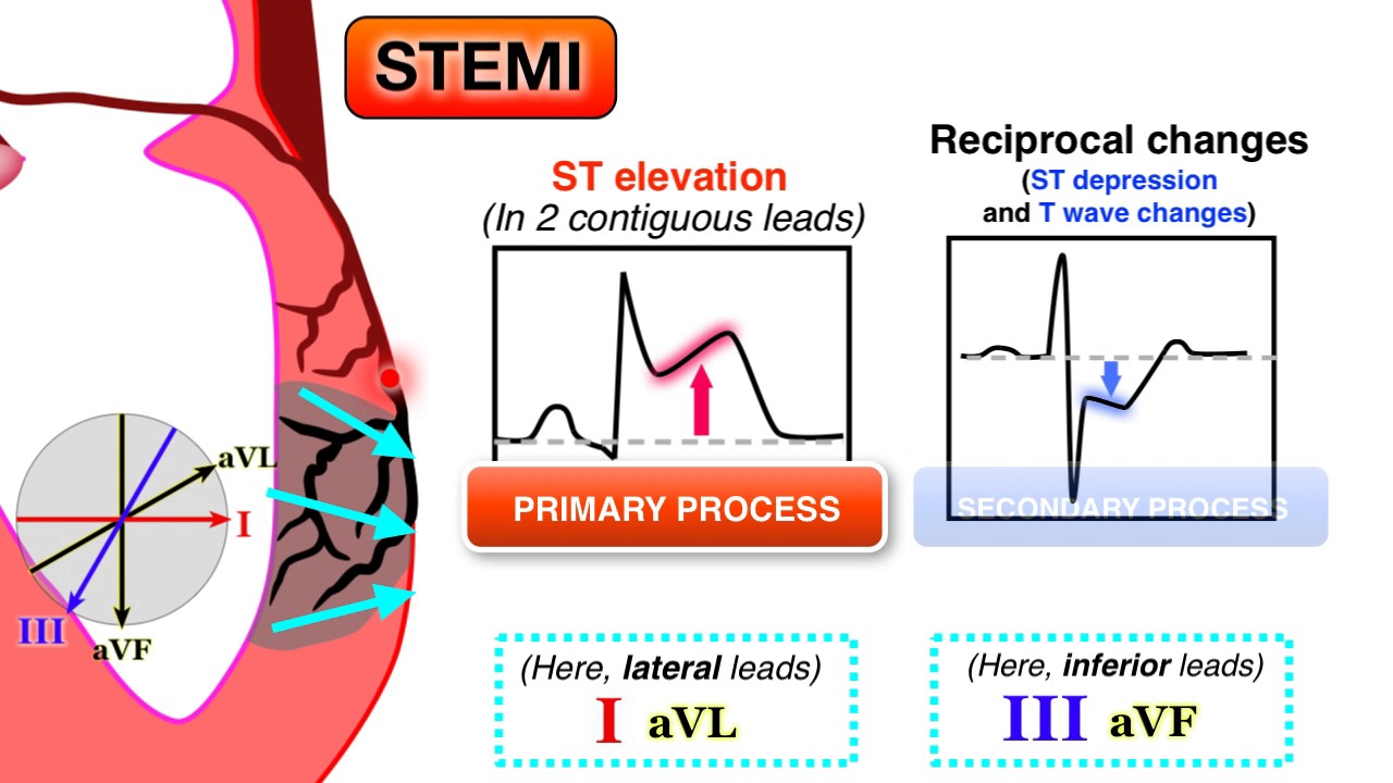 You are currently viewing Ischemia 6/7 – STEMI on ECG