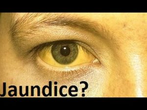 Read more about the article Jaundice and Neonatal Jaundice Explained- What is it and How do babies get Jaundice?