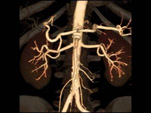 Read more about the article MDI Radiology – 3D CT Renal Angiogram