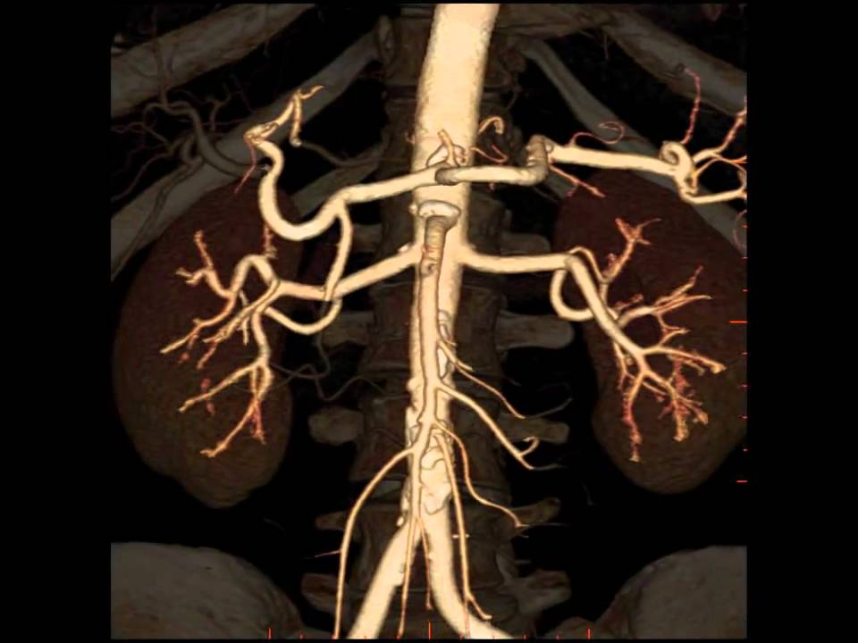You are currently viewing MDI Radiology – 3D CT Renal Angiogram