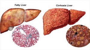 Read more about the article Main Causes Of Cirrhosis Of The Liver- Symptoms- Health Tips