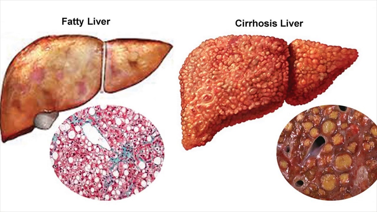 You are currently viewing Main Causes Of Cirrhosis Of The Liver- Symptoms- Health Tips