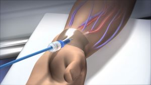 Read more about the article New Route to the Heart – Mayo Clinic