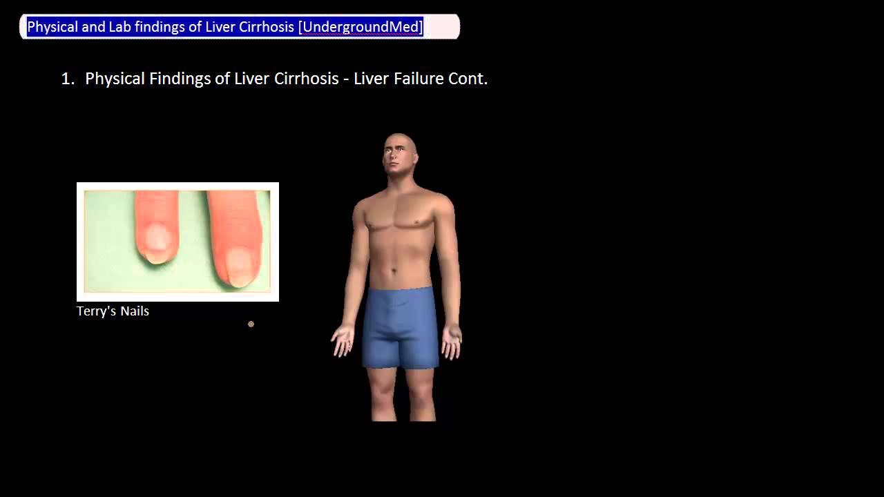 You are currently viewing Physical and Lab Findings of Liver Cirrhosis [UndergroundMed]