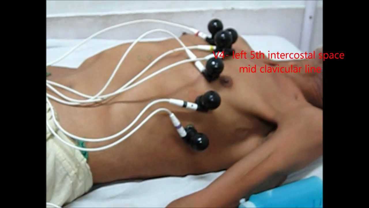 You are currently viewing Placements of Chest leads In ECG