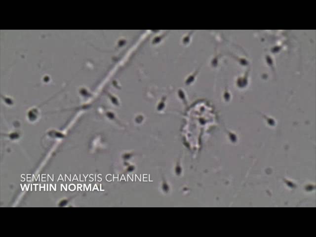You are currently viewing Semen Analysis – Within normal