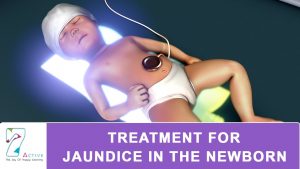 Read more about the article TREATMENT FOR JAUNDICE IN THE NEWBORN
