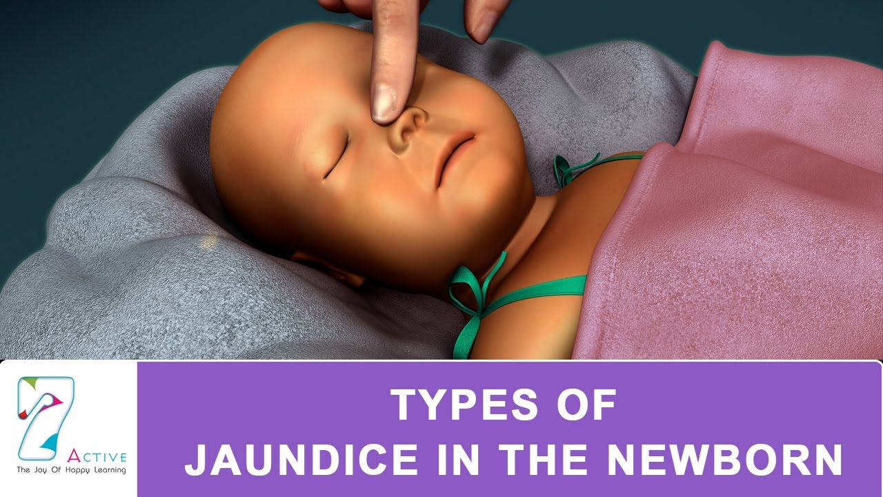 You are currently viewing TYPES OF JAUNDICE IN THE NEWBORN