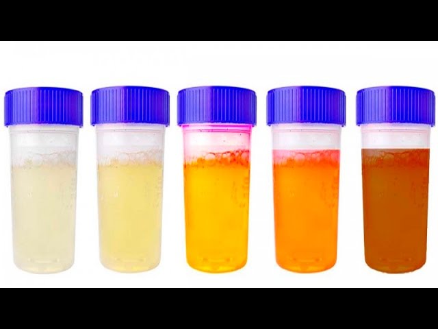 You are currently viewing The color of your urine says a lot about your health, this is what your color means