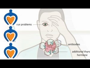 Thyroid problems – most common thyroid problems, symptoms and treatment
