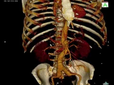 You are currently viewing Virtopsy – CT angiography (Volume Rendering)