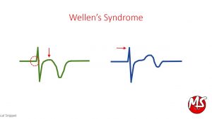 Wellen’s Syndrome – ECG (High Risk for Myocardial Infarction)