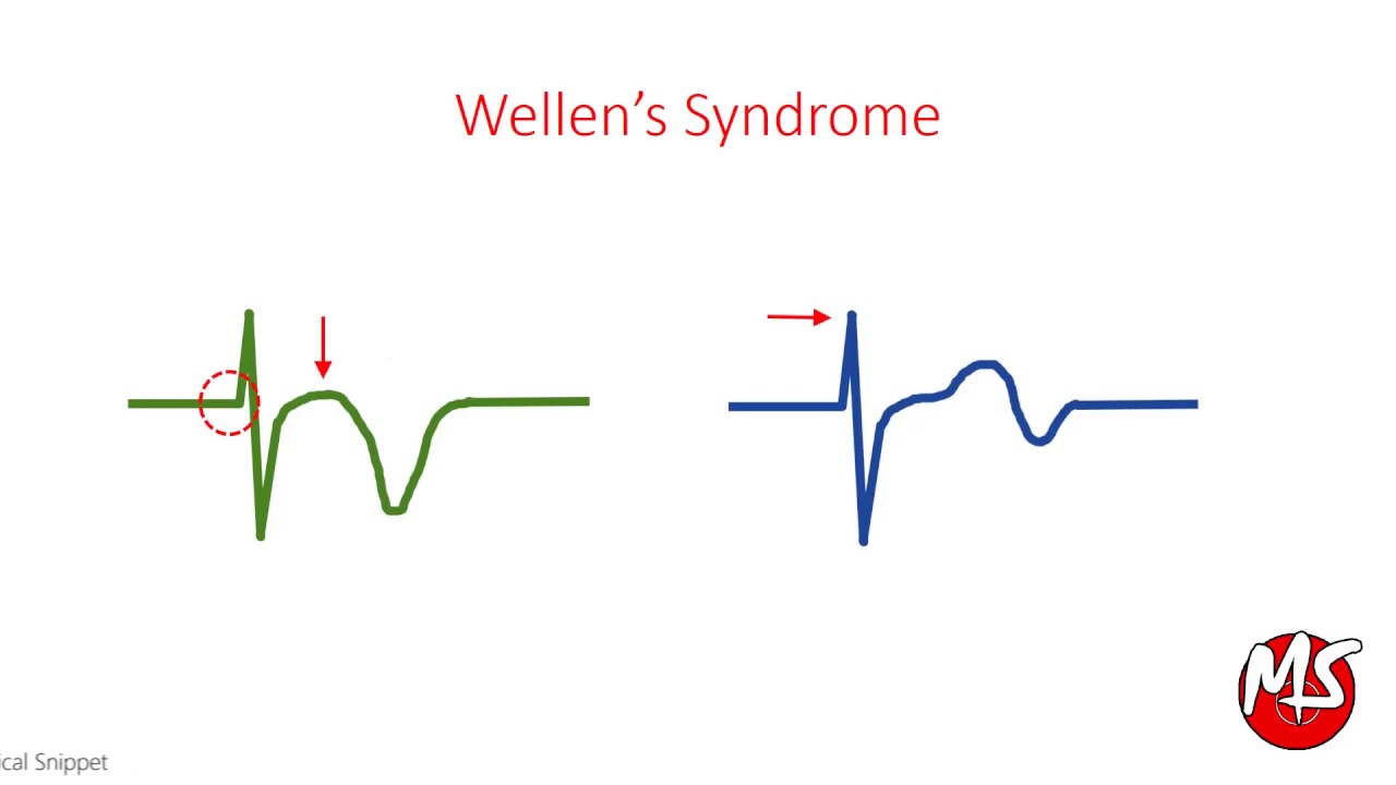 You are currently viewing Wellen’s Syndrome – ECG (High Risk for Myocardial Infarction)