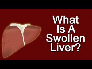 What Is A Swollen Liver?