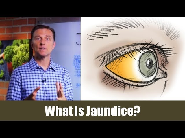 You are currently viewing What is Jaundice? (In Simple Terms)