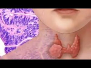Read more about the article What is Thyroid And What Are Its Symptoms?, Thyroid Disorders, Symptoms Of Thyroid Problems, Thyroid