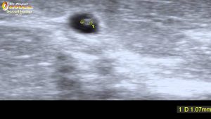Read more about the article early diagnosis of cancer breast ultrasound  2D HD Dr. Rafael Ortega Muñoz Ciudad Real