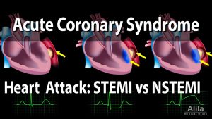 Acute Coronary Syndrome: Unstable Angina, NSTEMI and STEMI (Heart Attack), Animation