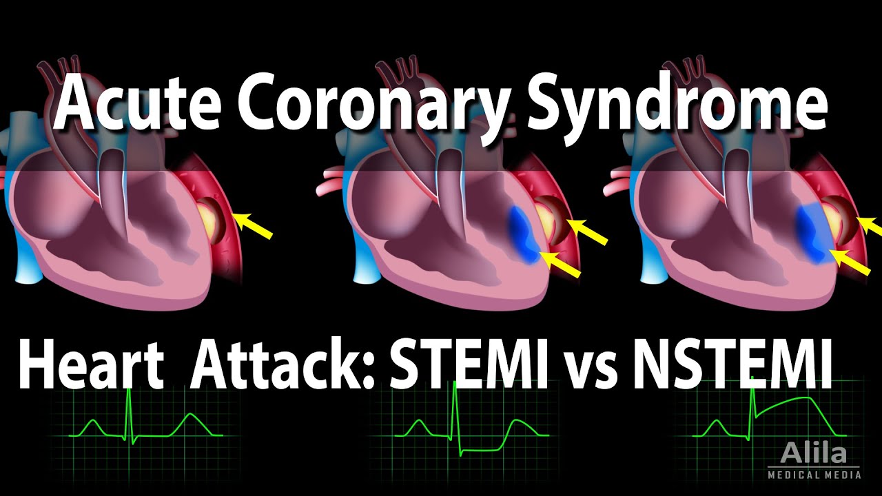 You are currently viewing Acute Coronary Syndrome: Unstable Angina, NSTEMI and STEMI (Heart Attack), Animation