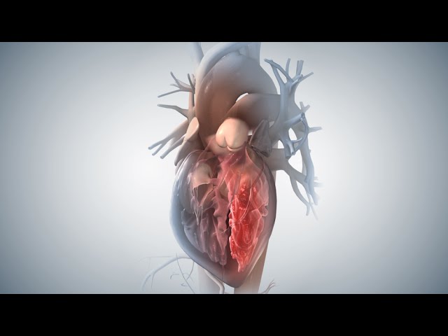 Acute Coronary Syndrome and Heart Attack