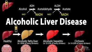 Alcoholic Liver Disease, Animation