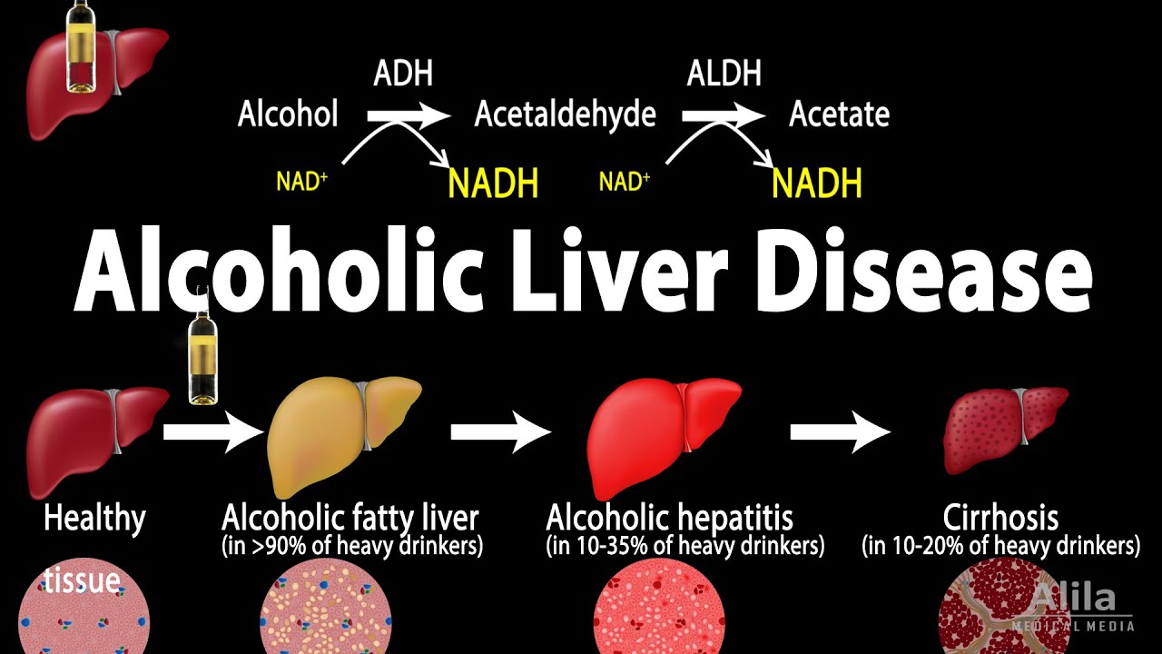 You are currently viewing Alcoholic Liver Disease, Animation