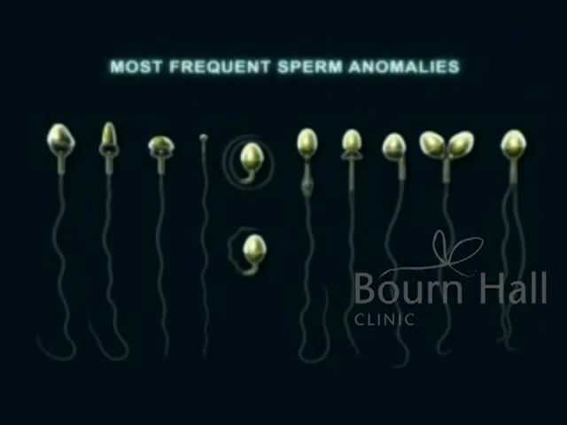 You are currently viewing Azoospermia Treatment | Semen Analysis at Bournhall Clinic India