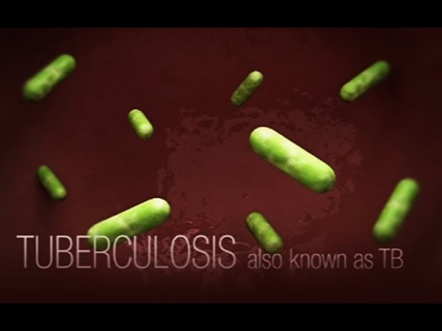 You are currently viewing CDC Tuberculosis (TB) Transmission and Pathogenesis Video