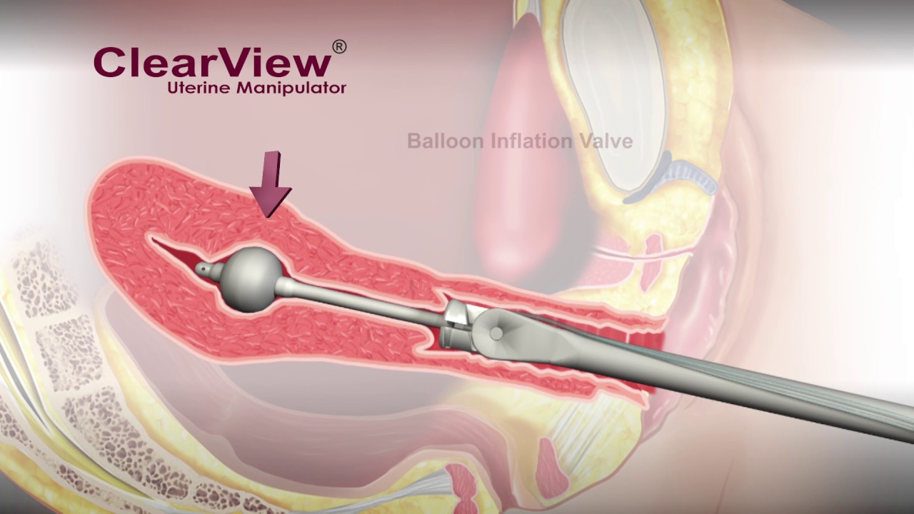 You are currently viewing ClearView® Uterine Manipulator – Animation