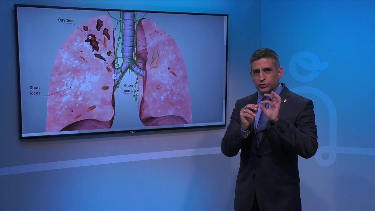 You are currently viewing Effects of Tuberculosis on Lungs