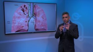 Effects of Tuberculosis on Lungs