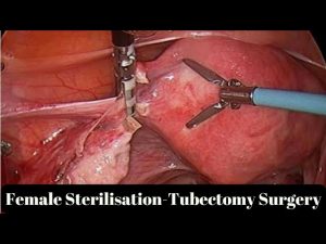 Female Sterilisation- Tubectomy Surgery..!! Laparoscopic Surgery..!!